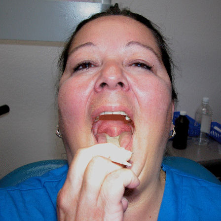 Uvula Infection Pictures